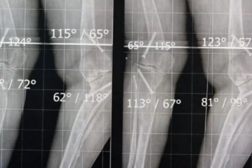 oedème osseux plateau tibial IRM