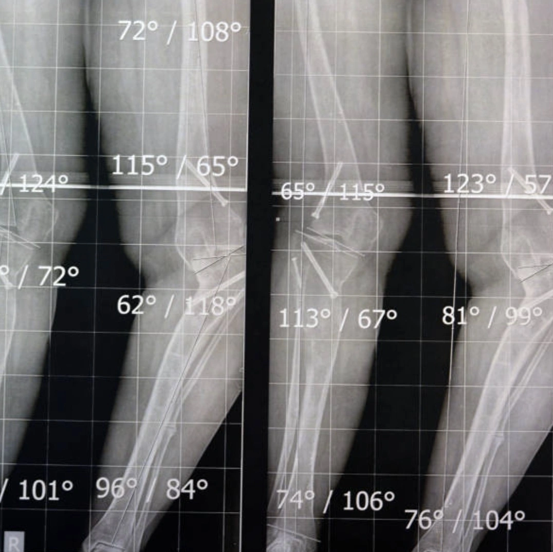 oedème osseux plateau tibial IRM