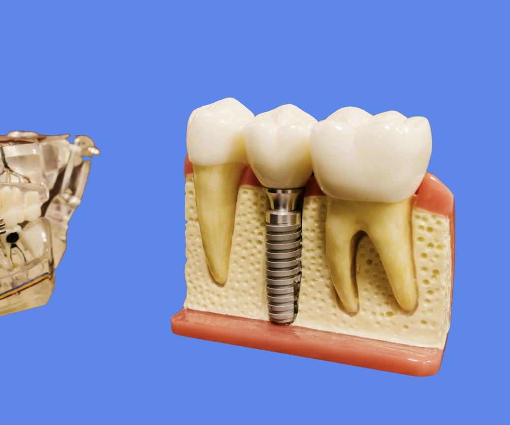 Douleur implant dentaire 10 ans après